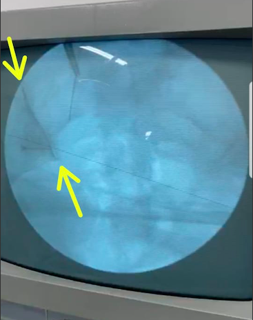Grupo de Neuromodulação da CTD realiza bloqueio de articulação sacroilíaca guiado por fluoroscopia