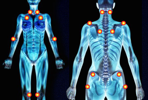 Fibromialgia: a doença que traz sintomas muito além das dores