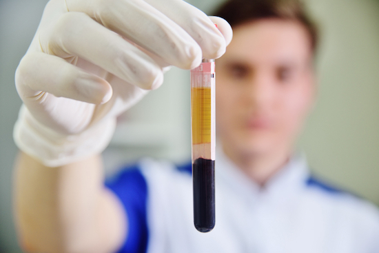 CFM regulamenta uso do Plasma Rico em Plaquetas para tratamento de doenças osteomusculares